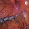 undefined UCS Undestanding Clinical Surgery - Pancreatitis